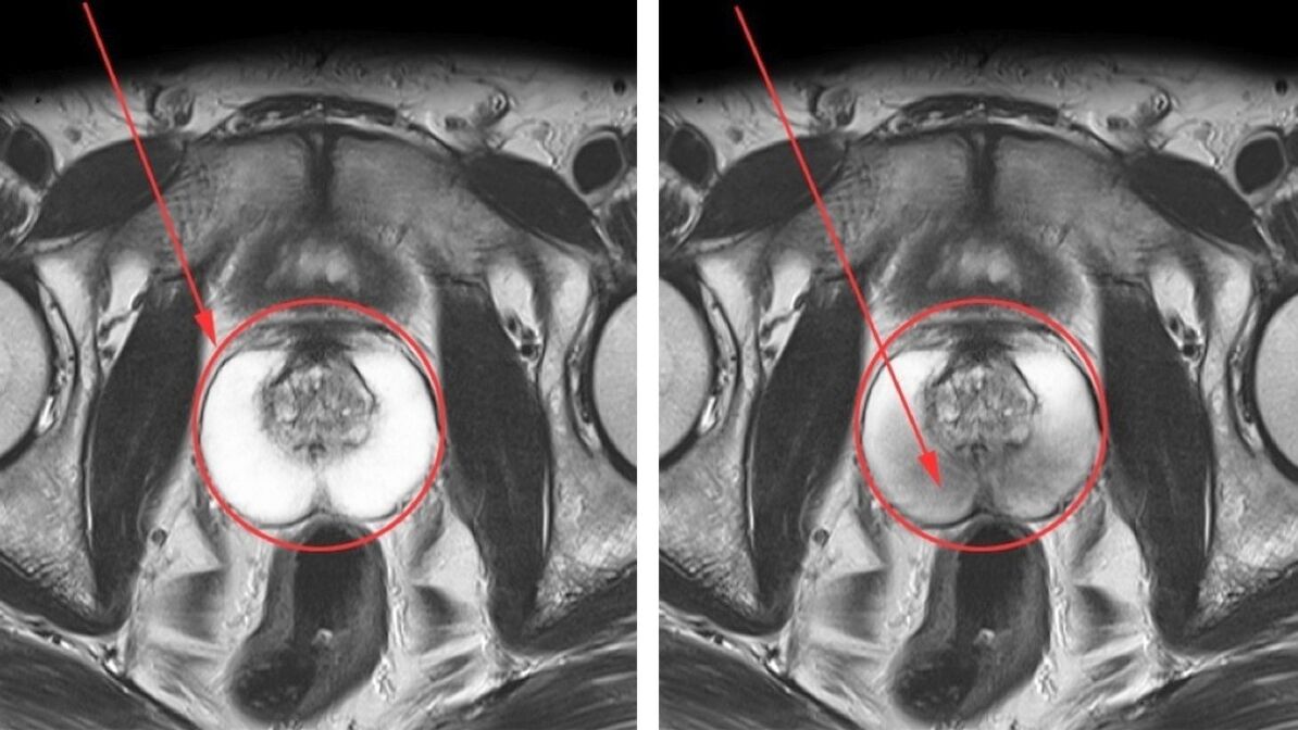 Ultraschall bei chronischer Prostatitis – gesunde (links) und entzündete (rechts) Prostata