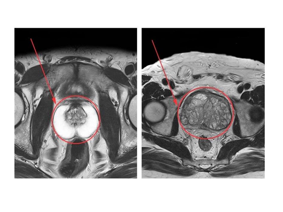 Vergleich zwischen einer gesunden Prostata (links) und einer entzündeten Prostata (rechts) auf MRT-Bildern