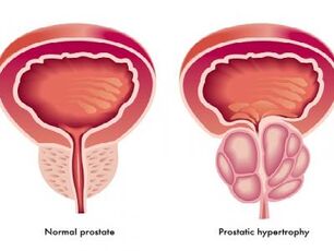 Normale und entzündete Prostata