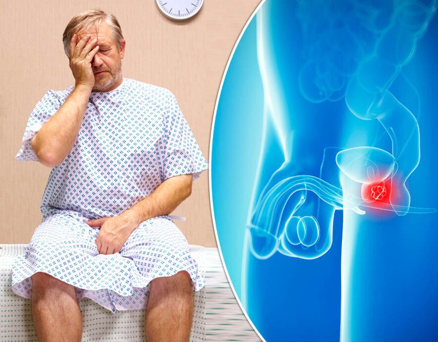 Bei einem Mann mit Prostatitis wird die Krankheit diagnostiziert