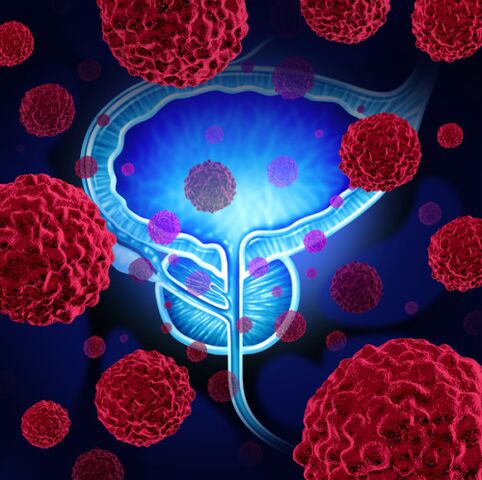 Die Aktivität pathogener Mikroorganismen ist die Ursache für die Entstehung einer Prostatitis