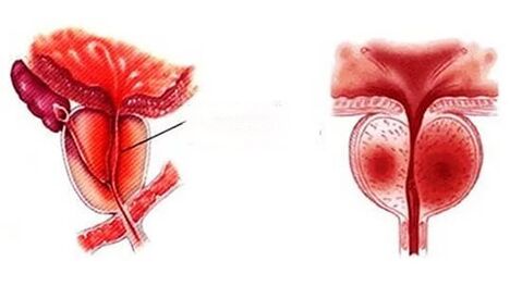 Was für eine chronische Prostatitis tut